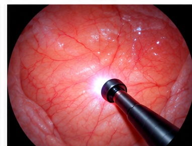 Endoscopic urinary tract examination and bladder stone evaluation